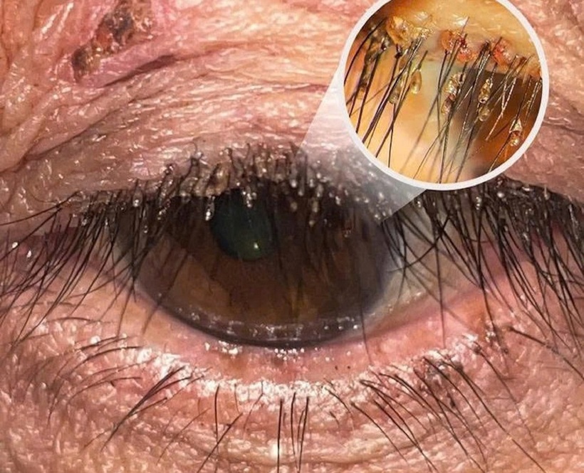 Ổ rận mu chi chít trên mi mắt bệnh nhân. Ảnh: VietNamNet.