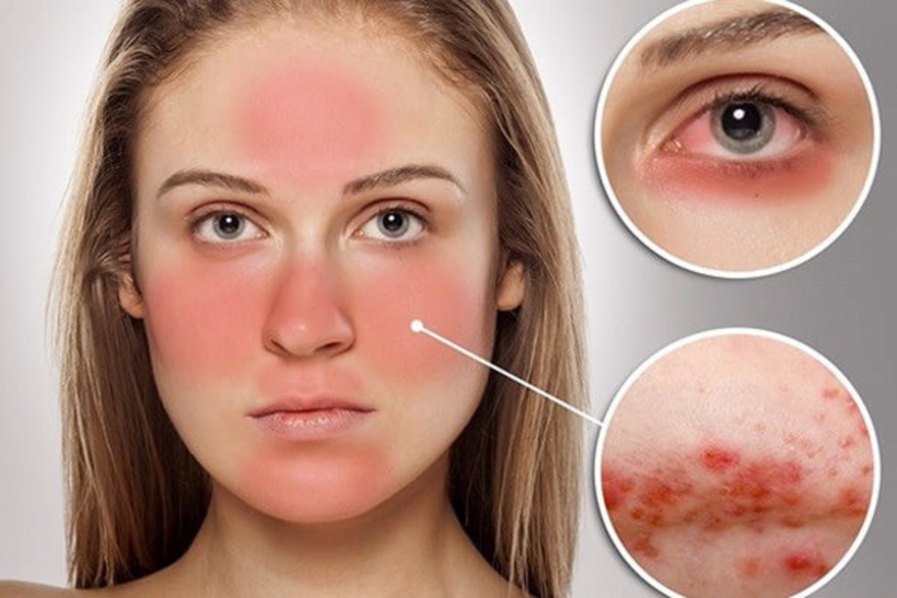 Lupus ban đỏ thường gặp ở phụ nữ trẻ do ảnh hưởng của nội tiết tố, di truyền và sự rối loạn miễn dịch trong cơ thể