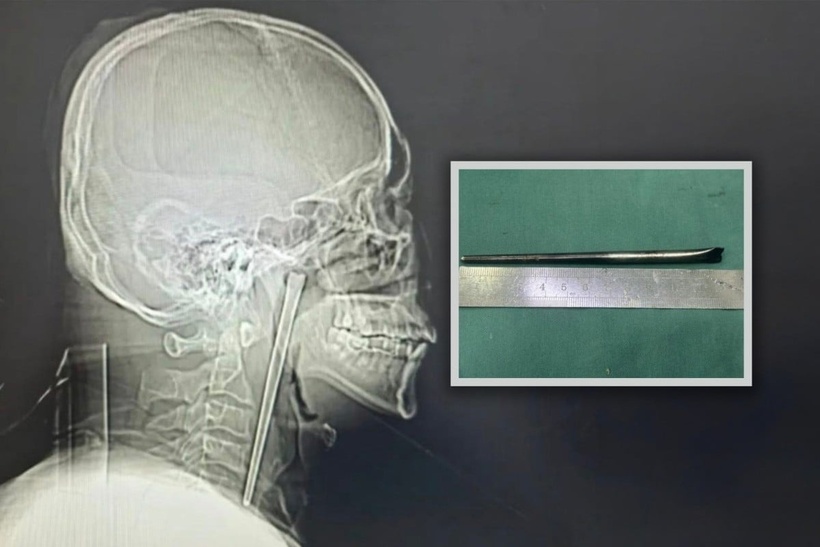 Chiếc đũa kim loại dài khoảng 12 cm trong họng bệnh nhân. Ảnh: SCMP/Weibo.