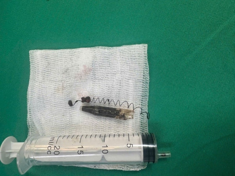 Hình ảnh X-quang dị vật trước khi can thiệp và sau khi được đưa ra khỏi vùng hố thái dương sau 13 năm. Ảnh: Đại biểu Nhân dân.