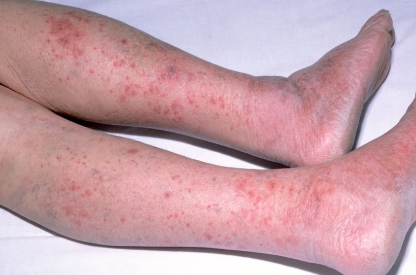 Bệnh do vi khuẩn não mô cầu có diễn tiến rất nhanh, từ triệu chứng giống cảm cúm đến sốc nhiễm trùng và tử vong chỉ trong vòng 24 giờ. Ảnh minh họa.