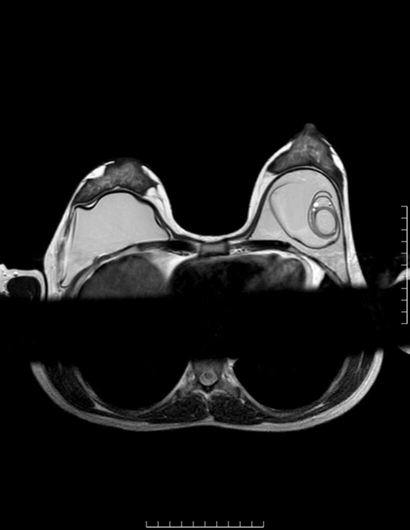 Hình ảnh CT vỡ túi ngực.Ảnh: BSCC