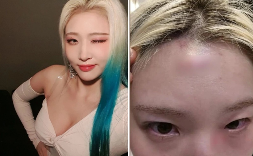 Ca sĩ Hyun Jung bị hành hung. (Ảnh: Chosun Biz)