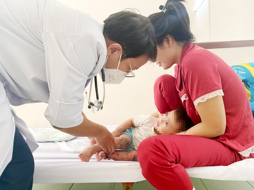 Bệnh nhi mắc tay chân miệng được bác sĩ điều trị. Ảnh: SGGP