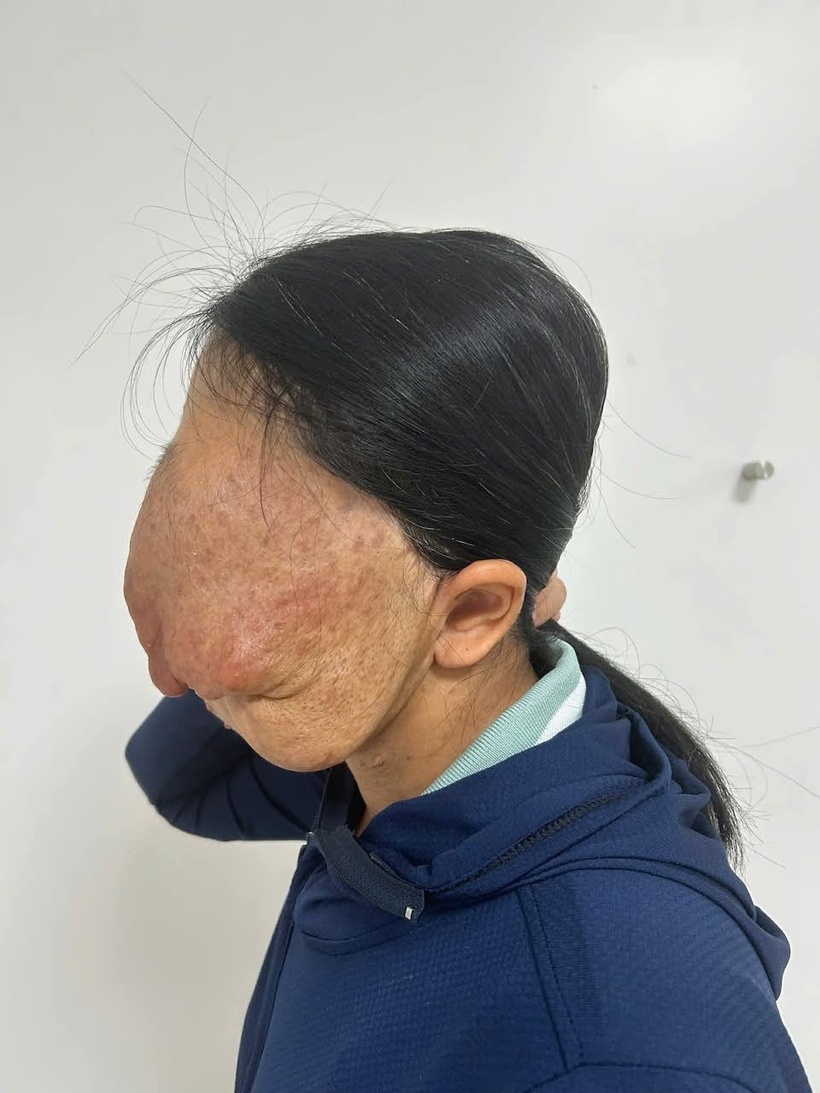 Khối u choán nửa mặt của bệnh nhân. Ảnh: VietNamNet.