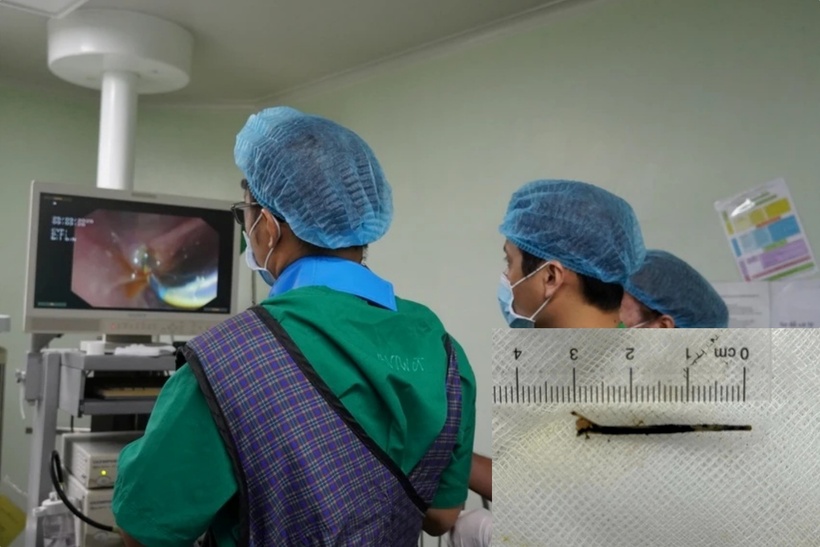 Đau bụng âm ỉ nhiều tháng không khỏi, chàng trai sốc nặng khi biết nguyên nhân. Ảnh: PLO.