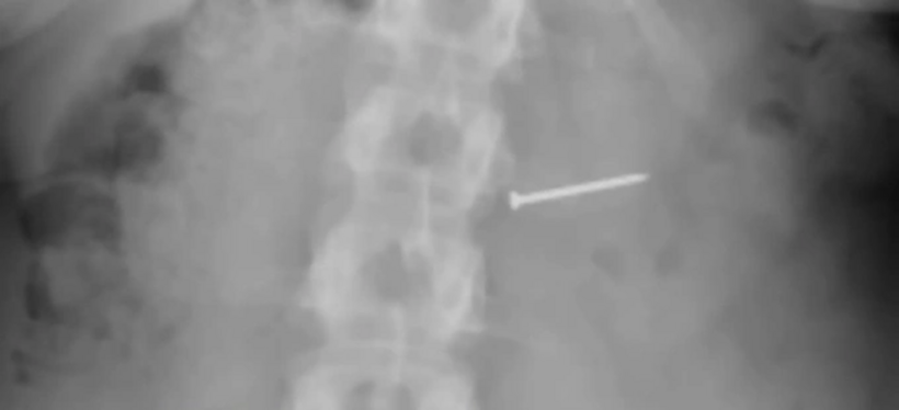 Hình ảnh chụp X quang của Brandy Buckley. Ảnh:&nbsp;NYPost