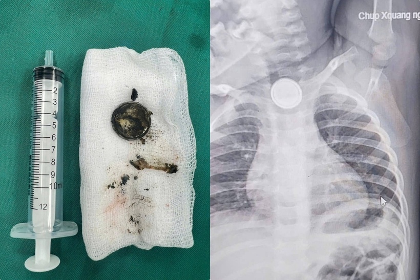 Bé 24 tháng tuổi bị bỏng sâu thực quản do nuốt pin cúc áo. Ảnh: Báo Sức khỏe và Đời sống.