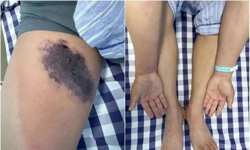 Vùng đùi trong bên phải của anh Trần bị bao phủ bởi những vùng da đỏ, bầm tím và phồng rộp lớn. Ảnh:&nbsp;Tencent.