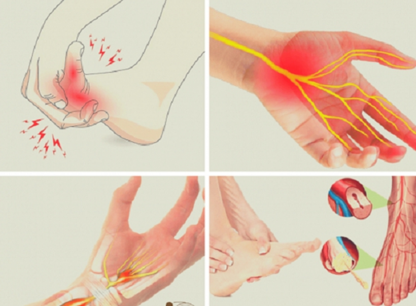 Tổn thương thần kinh là nguyên nhân gây tê bì chân tay ở người tiểu đường