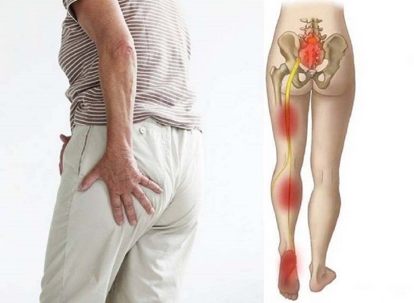 Thoát vị đĩa đệm L4 L5 chèn ép dây thần kinh gây đau thần kinh tọa