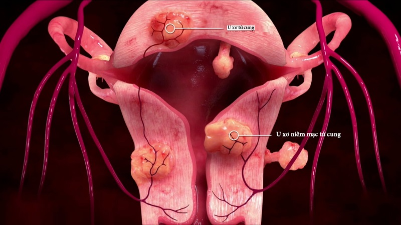 Ở tuổi sau 30 nguy cơ bị u xơ tử cung thường gia tăng