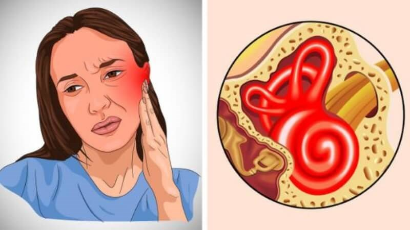 Thần kinh thính giác bị tổn thương là nguyên nhân gây ù tai