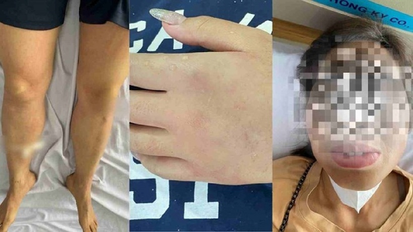 8 người nhập viện cấp cứu do ong rừng tấn công khi đi tảo mộ. Ảnh: Báo Lao động.