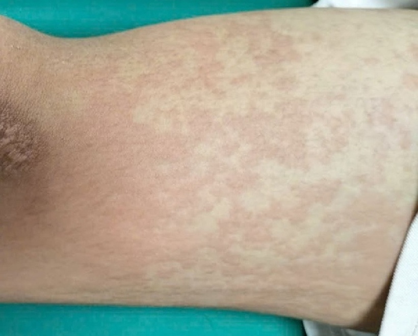 Ăn 2 con ve sầu, nam sinh 17 tuổi nhập viện cấp cứu trong đêm. Ảnh: Báo Người lao động.