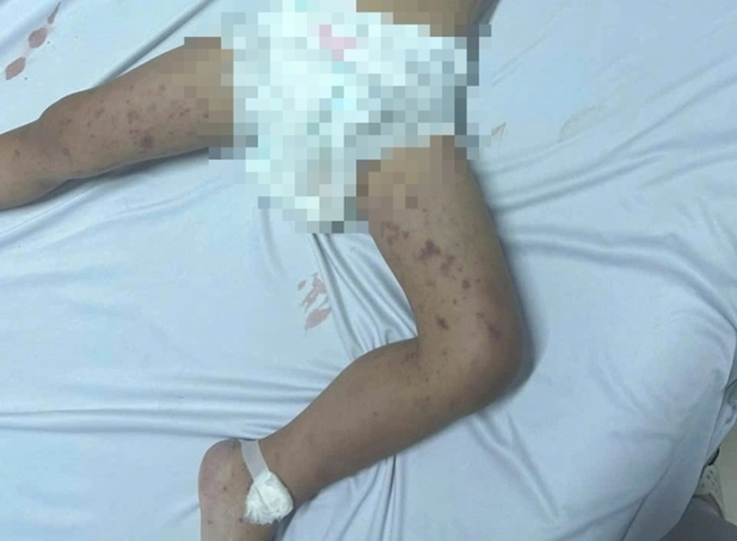 Đắk Lắk ghi nhận trường hợp tử vong do viêm não mô cầu. Ảnh: Thanh niên