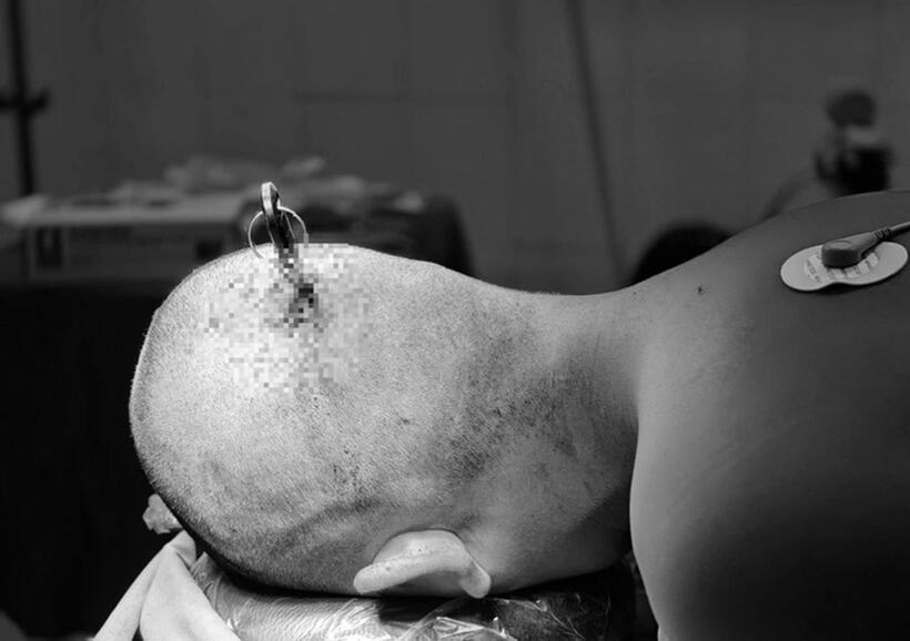 Nam sinh nhập viện với dị vật trên đầu. Ảnh: Bệnh viện Việt Đức