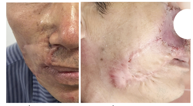 Ảnh trước và sau của bệnh nhân sau điều trị. Ảnh: BVCC