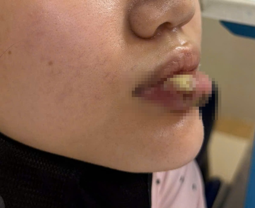Hình ảnh môi bị nhiễm trùng sau khi sau tiêm “giải filler” tại cơ sở không phép. Ảnh: BVCC