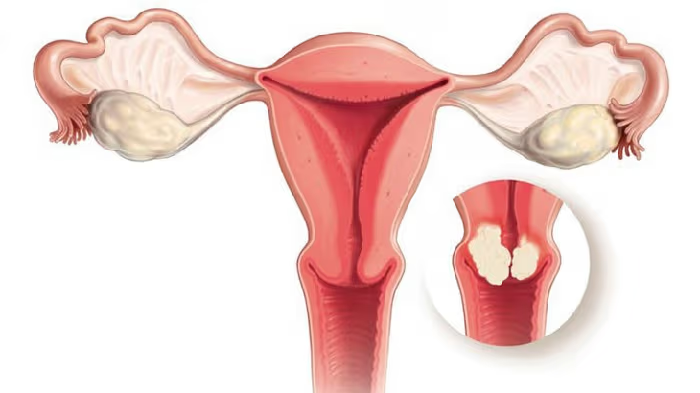 U xơ tử cung còn nhỏ là giai đoạn vàng cần kiểm soát