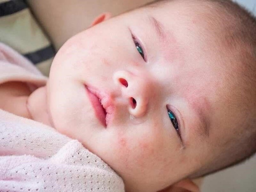 Viêm da là tình trạng thường gặp ở trẻ nhỏ