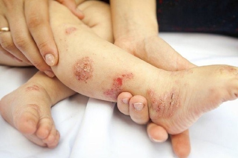 Viêm da khiến da bé ngứa ngáy khó chịu
