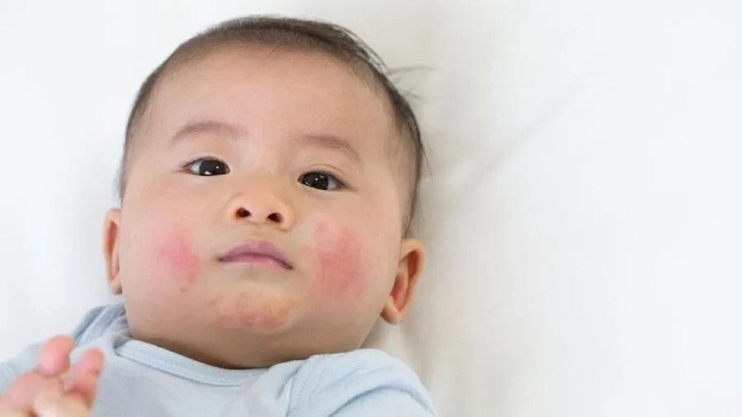 Chăm sóc viêm da cần hướng đến việc phục hồi chức năng tự nhiên của da