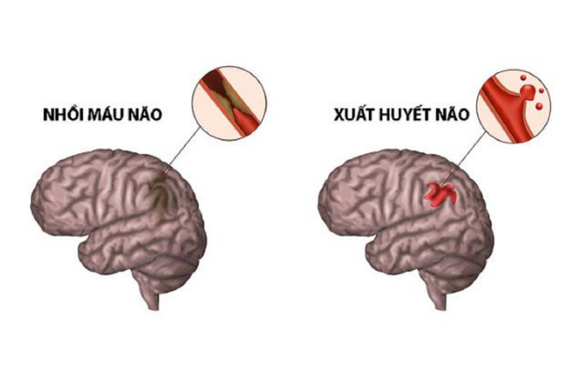 Tai biến mạch máu não gồm 2 dạng chính là nhồi máu não và xuất huyết não