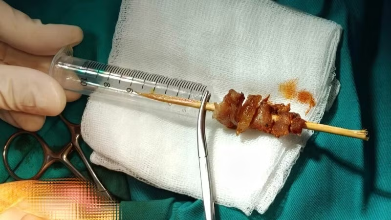 Dị vật gây tổn thương nghiêm trọng cho cháu bé. Ảnh: BVCC