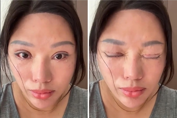 Người phụ nữ liên tục chảy nước mắt do di chứng của phẫu thuật hỏng. Ảnh: SCMP