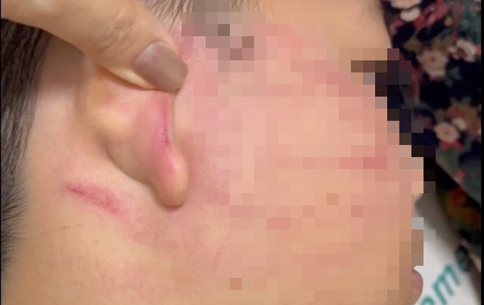 Học sinh lớp 4 bị thầy giáo Ấn Độ tát thủng màng nhĩ. Ảnh: Người lao động