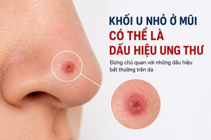 Khối u nhỏ ở mũi có thể là dấu hiệu ung thư. Ảnh minh họa