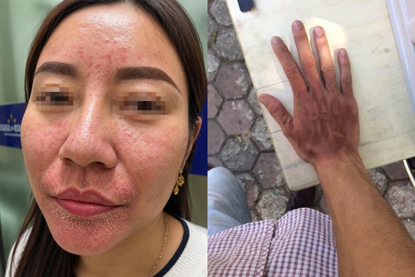 Nhiều người gặp tình trạng da bỏng dát sau khi tiếp xúc với nhiệt độ quá cao ngoài trời. Ảnh: BSCC