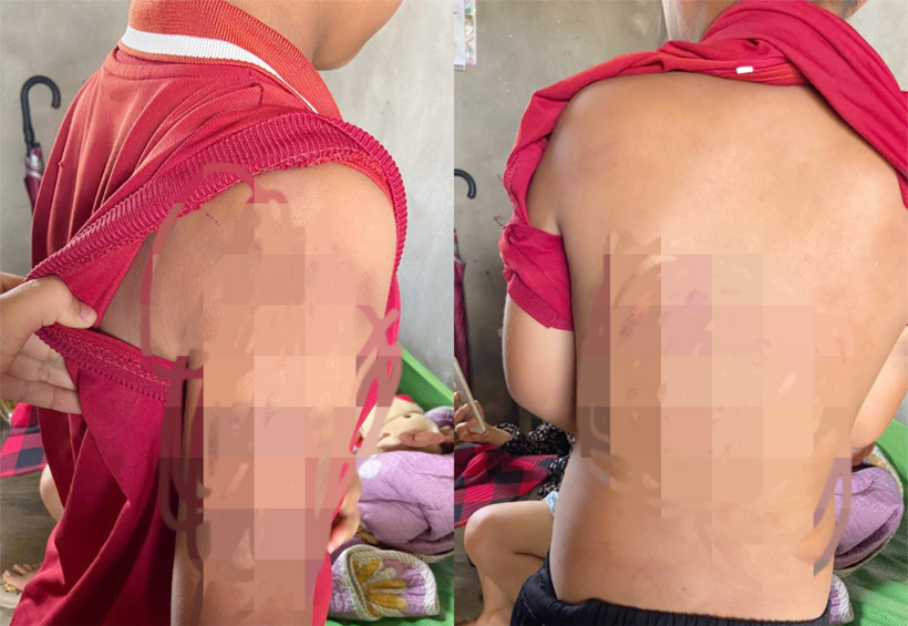 Trên người cháu U. có nhiều vết bầm tím. (Ảnh: VietnamNet)