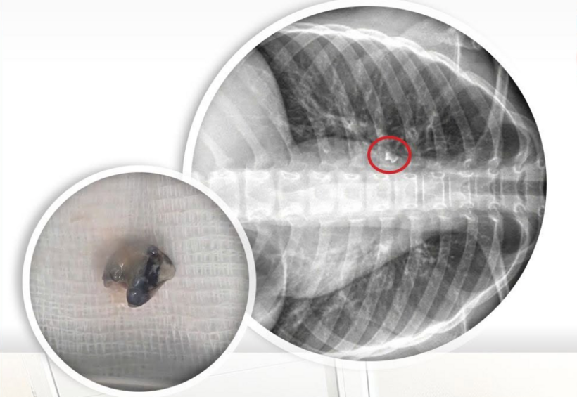 Chiếc răng mắc kẹt sâu trong phế quản bé trai 9 tuổi được gắp ra ngoài. Ảnh: Phụ nữ TP.HCM