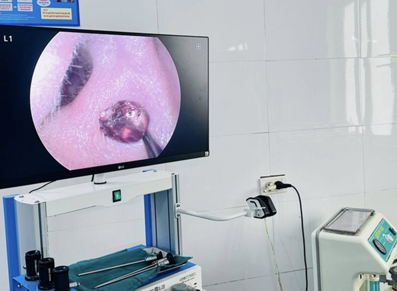 Hình ảnh con ve chó được phát hiện trong ống tai người bệnh qua hệ thống nội soi chuyên khoa Tai Mũi Họng. Ảnh: Sức khỏe & Đời sống