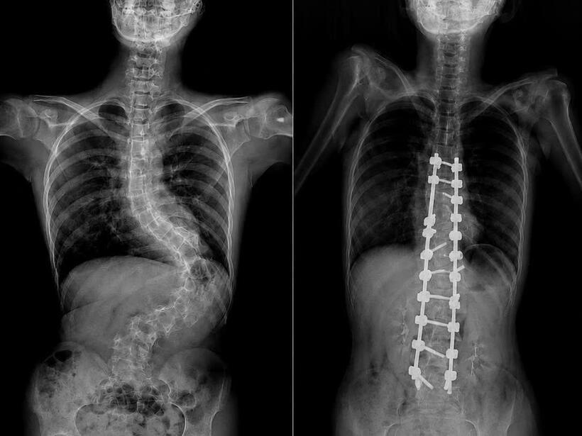 Hình ảnh cột sống của bé A. trước và sau khi thực hiện phẫu thuật