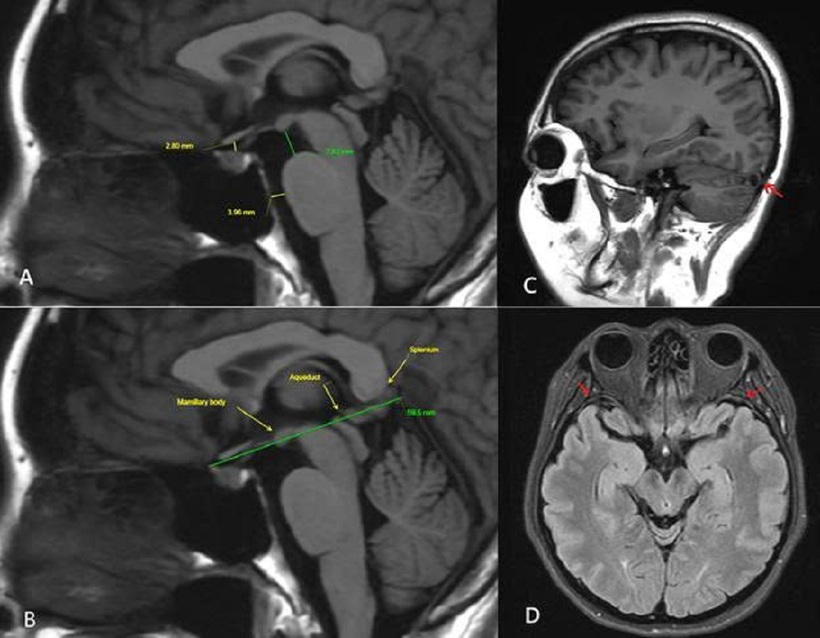 MRI sọ não lần 3 ghi nhận nhiều dấu hiệu gợi ý hội chứng giảm áp lực nội sọ do rò dịch não tủy, bao gồm: não sa thấp nhẹ, các khoang dịch quanh não thu hẹp, giãn các xoang tĩnh mạch nội sọ và dày nhẹ màng não.