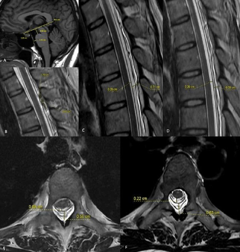 Hình ảnh MRI trước và sau thủ thuật vá máu ngoài màng cứng (EBP). Sau điều trị, khoang chứa dịch não tủy quanh tủy sống được mở rộng trở lại, trong khi khoang ngoài màng cứng thu hẹp rõ rệt. Những thay đổi này cho thấy áp lực dịch não tủy đã được cải thiện sau thủ thuật.