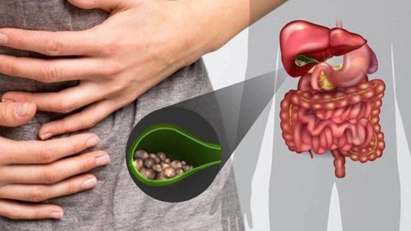 Đau hạ sườn phải sau ăn là biểu hiện thường gặp ở người sỏi túi mật.