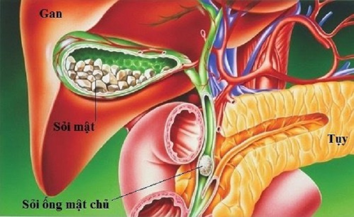 Sự mất cân bằng thành phần dịch mật là yếu tố quan trọng trong quá trình hình thành sỏi.