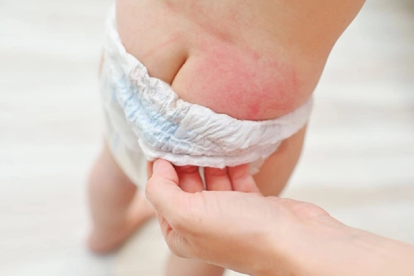 Hăm tã là tình trạng thường gặp ở trẻ nhỏ