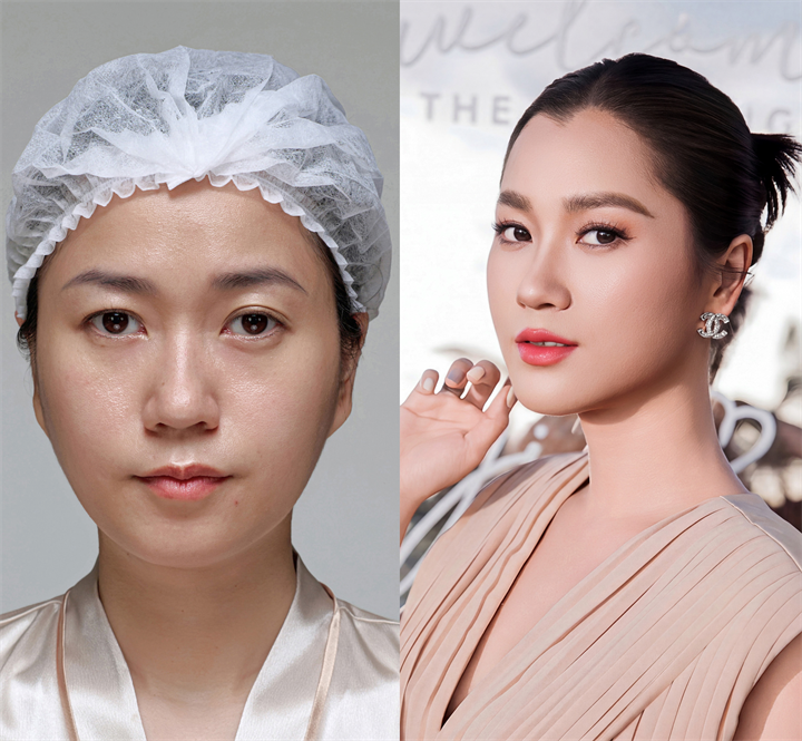 Lâm Vỹ Dạ lựa chọn hướng trẻ hóa hài hòa, tự nhiên. Ảnh: Quang Anh