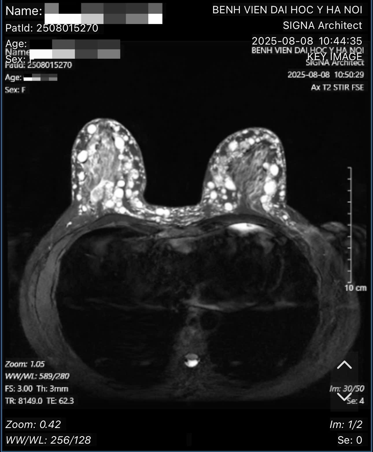 7 tiếng phẫu thuật cứu người phụ nữ bị hoại tử ngực vì tiêm silicon, bác sĩ bất ngờ phát hiện bệnh nhân mắc HIV nhưng giấu kín- Ảnh 3.