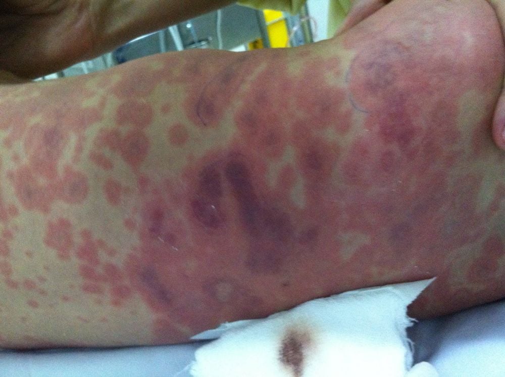 viem mang nao mo cau 1