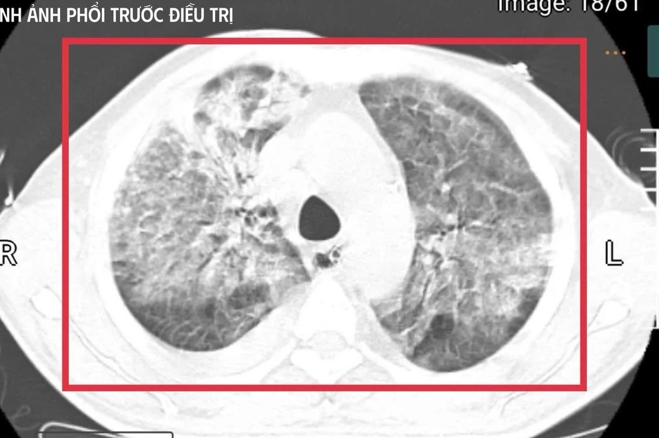 vi khuan an thit nguoi 2