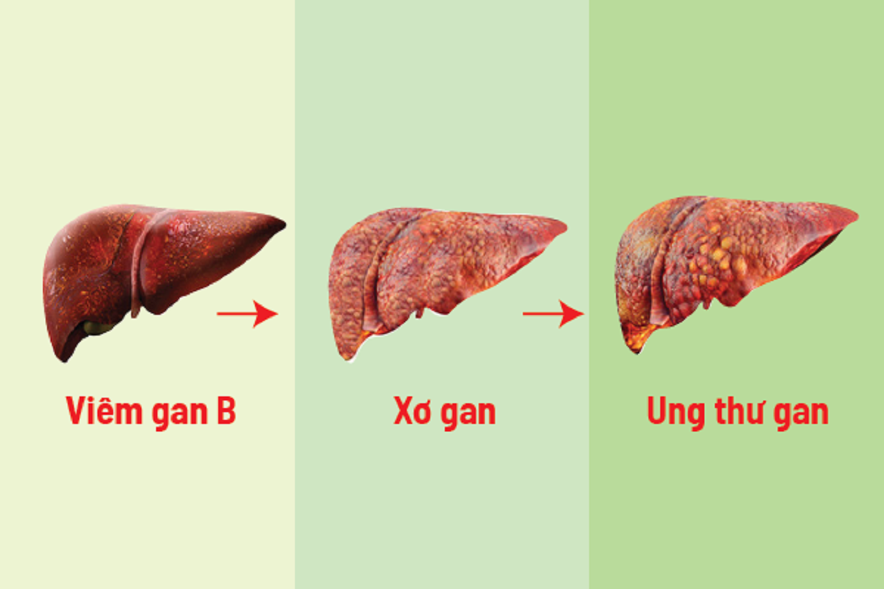 viem gan b chuyen sang xo gan
