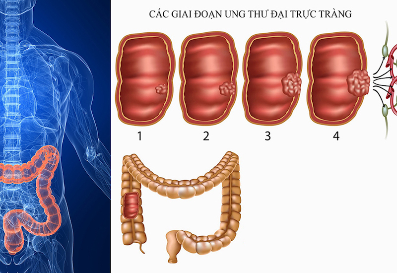 20220926ung thu dai trang giai doan 3 2