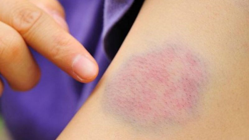 14 dau hieu cua benh gan va cac benh ve gan 12 800x450