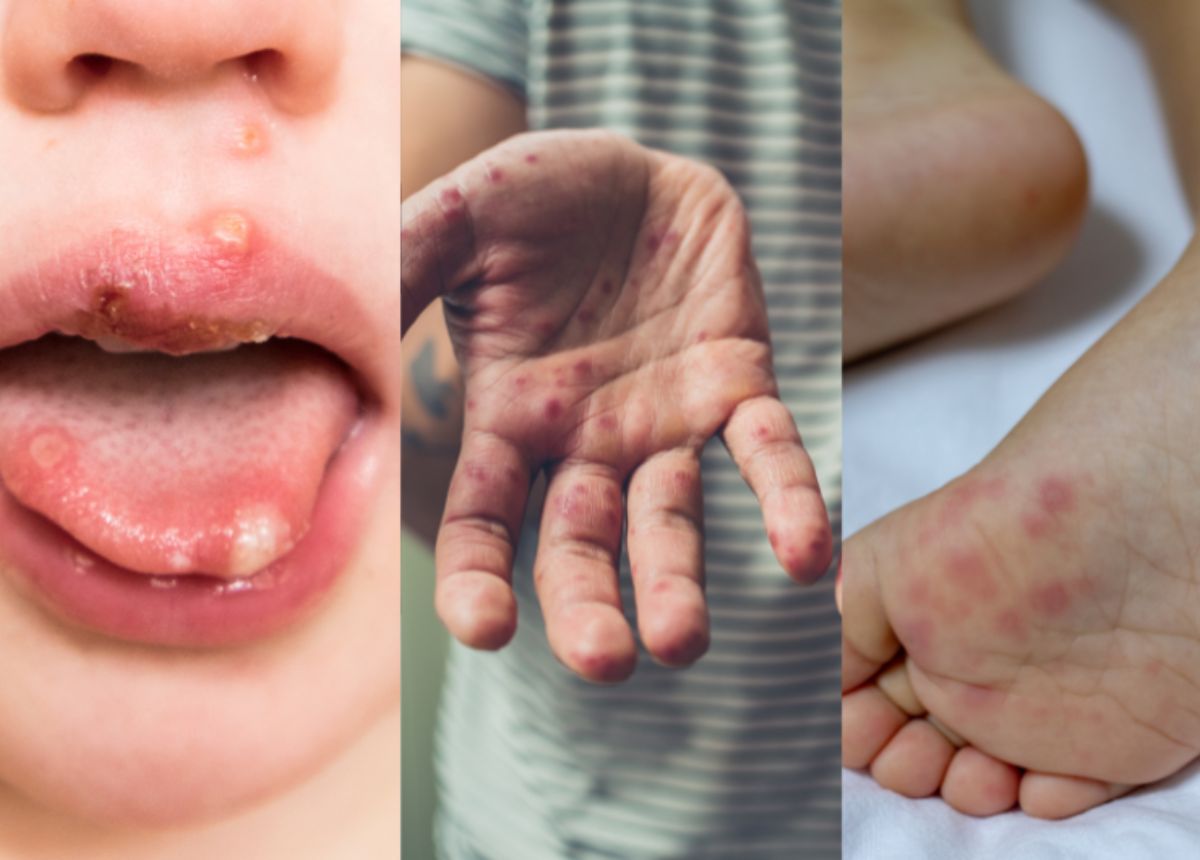 benh tay chan mieng o tre em